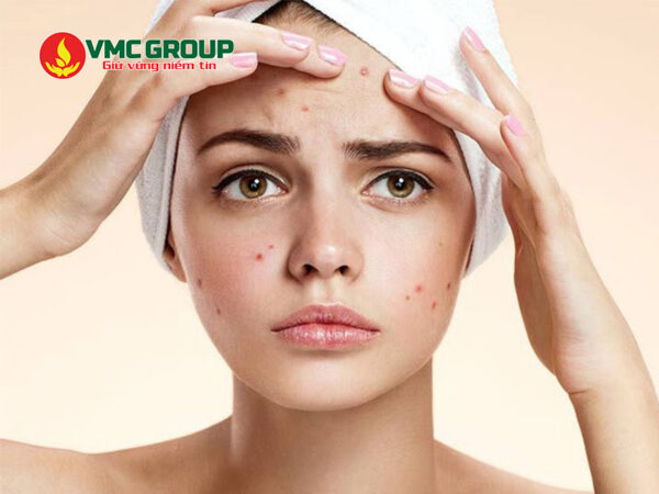 Acid lauric giúp điều trị mụn trên da hiệu quả