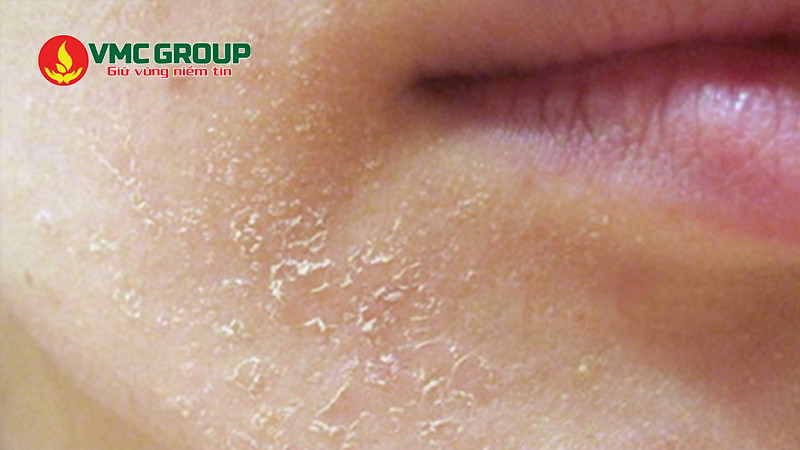Vaseline được dùng làm chất dưỡng ẩm da